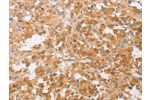 The image on the left is immunohistochemistry of paraffin-embedded Human thyroid cancer tissue using CSB-PA075339(CDKN2C Antibody) at dilution 1/25, on the right is treated with fusion protein. (Original magnification: 