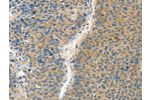 The image on the left is immunohistochemistry of paraffin-embedded Human liver cancer tissue using CSB-PA075666(ASPA Antibody) at dilution 1/60, on the right is treated with fusion protein. (Original magnification: 