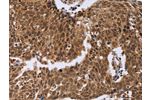 The image on the left is immunohistochemistry of paraffin-embedded Human cervical cancer tissue using CSB-PA076186(ERCC6L Antibody) at dilution 1/30, on the right is treated with fusion protein. (Original magnification: 