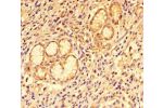 Immunohistochemistry of paraffin-embedded human gastric cancer using CSB-PA07629A0Rb at dilution of 1:100