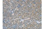 The image on the left is immunohistochemistry of paraffin-embedded Human lymphoma tissue using CSB-PA076734(ATF2 Antibody) at dilution 1/15, on the right is treated with fusion protein. (Original magnification: 