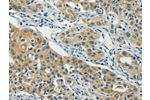 The image on the left is immunohistochemistry of paraffin-embedded Human lung cancer tissue using CSB-PA076840(ASAH2 Antibody) at dilution 1/40, on the right is treated with fusion protein. (Original magnification: 
