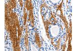 The image on the left is immunohistochemistry of paraffin-embedded Human stomach cancer tissue using CSB-PA076907(AQP1 Antibody) at dilution 1/5, on the right is treated with synthetic peptide. (Original magnification: 