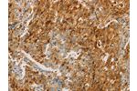The image on the left is immunohistochemistry of paraffin-embedded Human gastic cancer tissue using CSB-PA077200(CEACAM8 Antibody) at dilution 1/30, on the right is treated with fusion protein. (Original magnification: 