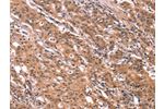 The image on the left is immunohistochemistry of paraffin-embedded Human gastic cancer tissue using CSB-PA077924(FGF22 Antibody) at dilution 1/20, on the right is treated with synthetic peptide. (Original magnification: 