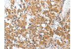 The image on the left is immunohistochemistry of paraffin-embedded Human thyroid cancer tissue using CSB-PA078194(CHMP4B Antibody) at dilution 1/40, on the right is treated with fusion protein. (Original magnification: 