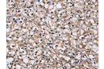 The image on the left is immunohistochemistry of paraffin-embedded Human prostate cancer tissue using CSB-PA078374(DYNLL1 Antibody) at dilution 1/25, on the right is treated with fusion protein. (Original magnification: 