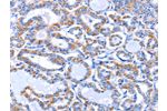 The image on the left is immunohistochemistry of paraffin-embedded Human thyroid cancer tissue using CSB-PA078489(GJB3 Antibody) at dilution 1/30, on the right is treated with fusion protein. (Original magnification: 