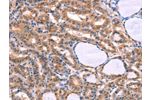 The image on the left is immunohistochemistry of paraffin-embedded Human thyroid cancer tissue using CSB-PA078505(CYP1B1 Antibody) at dilution 1/20, on the right is treated with fusion protein. (Original magnification: 