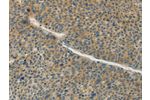The image on the left is immunohistochemistry of paraffin-embedded Human liver cancer tissue using CSB-PA078531(GJC1 Antibody) at dilution 1/50, on the right is treated with synthetic peptide. (Original magnification: 