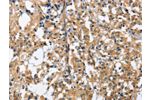 The image on the left is immunohistochemistry of paraffin-embedded Human thyroid cancer tissue using CSB-PA078640(GAB1 Antibody) at dilution 1/40, on the right is treated with fusion protein. (Original magnification: 