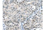 The image on the left is immunohistochemistry of paraffin-embedded Human breast cancer tissue using CSB-PA078687(CCNA1 Antibody) at dilution 1/20, on the right is treated with fusion protein. (Original magnification: 