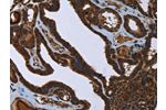 The image on the left is immunohistochemistry of paraffin-embedded Human thyroid cancer tissue using CSB-PA078717(FASTKD2 Antibody) at dilution 1/45, on the right is treated with fusion protein. (Original magnification: 
