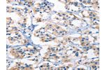 The image on the left is immunohistochemistry of paraffin-embedded Human thyroid cancer tissue using CSB-PA078954(AHR Antibody) at dilution 1/50, on the right is treated with synthetic peptide. (Original magnification: 