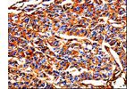 The image on the left is immunohistochemistry of paraffin-embedded Human liver cancer tissue using CSB-PA079344(ALB Antibody) at dilution 1/25, on the right is treated with fusion protein. (Original magnification: 