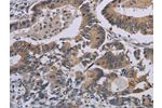 The image on the left is immunohistochemistry of paraffin-embedded Human colon cancer tissue using CSB-PA079873(CCL1 Antibody) at dilution 1/50, on the right is treated with synthetic peptide. (Original magnification: 