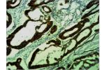 Immunohistochemical analysis of paraffin-embedded human Colon caricnoma using COX4 Polyclonal Antibody.