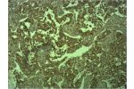 Immunohistochemical analysis of paraffin-embedded human Lung caricnoma using E-cadherin Polyclonal Antibody.