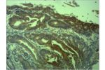 Immunohistochemical analysis of paraffin-embedded human Colon caricnoma using Survivin Polyclonal Antibody.