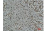 Immunohistochemical analysis of paraffin-embedded Human Breast Carcinoma using GAPDH Polyclonal Antibody.