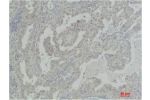 Immunohistochemical analysis of paraffin-embedded Human Lung Carcinoma using Akt2 Polyclonal Antibody.