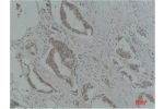 Immunohistochemical analysis of paraffin-embedded Human Breast Carcinoma using p21 Polyclonal Antibody.