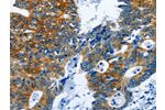 The image on the left is immunohistochemistry of paraffin-embedded Human colon cancer tissue using CSB-PA080665(BPIFB3 Antibody) at dilution 1/120, on the right is treated with synthetic peptide. (Original magnification: 