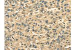 The image on the left is immunohistochemistry of paraffin-embedded Human liver cancer tissue using CSB-PA081479(ANXA2 Antibody) at dilution 1/35, on the right is treated with fusion protein. (Original magnification: 