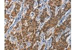 The image on the left is immunohistochemistry of paraffin-embedded Human gastic cancer tissue using CSB-PA082663(APOL1 Antibody) at dilution 1/40, on the right is treated with synthetic peptide. (Original magnification: 
