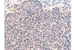The image on the left is immunohistochemistry of paraffin-embedded Human lung cancer tissue using CSB-PA082817(CCL7 Antibody) at dilution 1/20, on the right is treated with synthetic peptide. (Original magnification: 