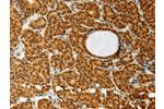 The image on the left is immunohistochemistry of paraffin-embedded Human thyroid cancer tissue using CSB-PA082936(AKR1A1 Antibody) at dilution 1/30, on the right is treated with synthetic peptide. (Original magnification: 