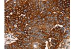 The image on the left is immunohistochemistry of paraffin-embedded Human breast cancer tissue using CSB-PA083210(EDAR Antibody) at dilution 1/45, on the right is treated with synthetic peptide. (Original magnification: 
