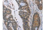 The image on the left is immunohistochemistry of paraffin-embedded Human colon cancer tissue using CSB-PA083278(AMBP Antibody) at dilution 1/35, on the right is treated with fusion protein. (Original magnification: 