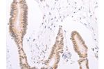 The image on the left is immunohistochemistry of paraffin-embedded Human colon cancer tissue using CSB-PA083402(ADAM12 Antibody) at dilution 1/30, on the right is treated with synthetic peptide. (Original magnification: 