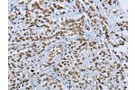The image on the left is immunohistochemistry of paraffin-embedded Human prostate cancer tissue using CSB-PA083549(FOXE1  Antibody) at dilution 1/25, on the right is treated with synthetic peptide. (Original magnification: 