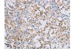 The image on the left is immunohistochemistry of paraffin-embedded Human thyroid cancer tissue using CSB-PA083613(CERKL Antibody) at dilution 1/50, on the right is treated with synthetic peptide. (Original magnification: 