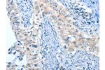 The image on the left is immunohistochemistry of paraffin-embedded Human cervical cancer tissue using CSB-PA083784(ANGPT2 Antibody) at dilution 1/45, on the right is treated with fusion protein. (Original magnification: 
