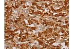 The image on the left is immunohistochemistry of paraffin-embedded Human thyroid cancer tissue using CSB-PA084239(BNIP3 Antibody) at dilution 1/20, on the right is treated with fusion protein. (Original magnification: 