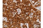 The image on the left is immunohistochemistry of paraffin-embedded Human lung cancer tissue using CSB-PA084372(CDC27 Antibody) at dilution 1/20, on the right is treated with synthetic peptide. (Original magnification: 