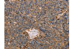 The image on the left is immunohistochemistry of paraffin-embedded Human liver cancer tissue using CSB-PA084581(ACTA1 Antibody) at dilution 1/65, on the right is treated with fusion protein. (Original magnification: 