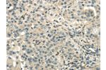 The image on the left is immunohistochemistry of paraffin-embedded Human breast cancer tissue using CSB-PA084734(DLAT Antibody) at dilution 1/40, on the right is treated with fusion protein. (Original magnification: 
