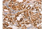 The image on the left is immunohistochemistry of paraffin-embedded Human thyroid cancer tissue using CSB-PA086010(CABLES2 Antibody) at dilution 1/25, on the right is treated with synthetic peptide. (Original magnification: 