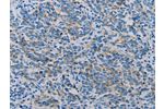 The image on the left is immunohistochemistry of paraffin-embedded Human breast cancer tissue using CSB-PA086155(CLDN4 Antibody) at dilution 1/35, on the right is treated with synthetic peptide. (Original magnification: 