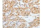 The image on the left is immunohistochemistry of paraffin-embedded Human liver cancer tissue using CSB-PA086320(BPIFB2 Antibody) at dilution 1/45, on the right is treated with synthetic peptide. (Original magnification: 