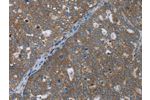 The image on the left is immunohistochemistry of paraffin-embedded Human ovarian cancer tissue using CSB-PA086437(GABRB1 Antibody) at dilution 1/50, on the right is treated with fusion protein. (Original magnification: 