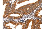 The image on the left is immunohistochemistry of paraffin-embedded Human cervical cancer tissue using CSB-PA086441(FGFR1 Antibody) at dilution 1/60, on the right is treated with fusion protein. (Original magnification: 