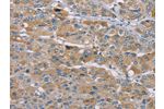 The image on the left is immunohistochemistry of paraffin-embedded Human liver cancer tissue using CSB-PA086653(SAMD9L Antibody) at dilution 1/35, on the right is treated with synthetic peptide. (Original magnification: 