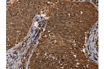 The image on the left is immunohistochemistry of paraffin-embedded Human cervical cancer tissue using CSB-PA086956(DCP1A Antibody) at dilution 1/50, on the right is treated with fusion protein. (Original magnification: 