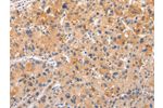 The image on the left is immunohistochemistry of paraffin-embedded Human liver cancer tissue using CSB-PA086984(AP2A1 Antibody) at dilution 1/20, on the right is treated with synthetic peptide. (Original magnification: 