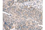 The image on the left is immunohistochemistry of paraffin-embedded Human ovarian cancer tissue using CSB-PA087606(DECR1 Antibody) at dilution 1/50, on the right is treated with synthetic peptide. (Original magnification: 